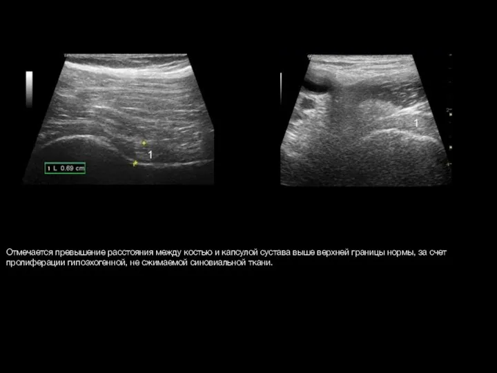 Отмечается превышение расстояния между костью и капсулой сустава выше верхней границы