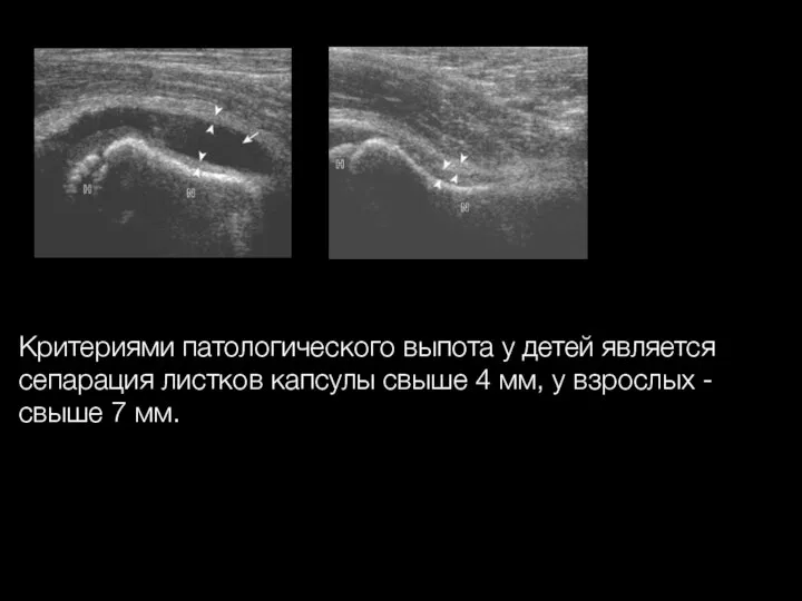 Критериями патологического выпота у детей является сепарация листков капсулы свыше 4