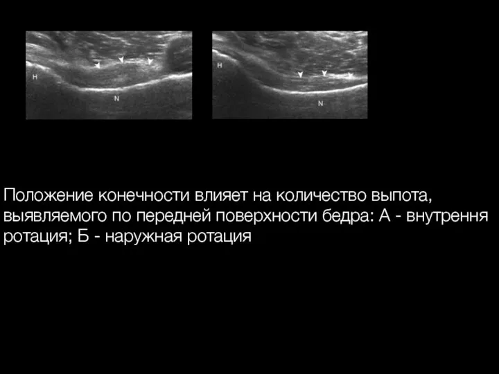 Положение конечности влияет на количество выпота, выявляемого по передней поверхности бедра: