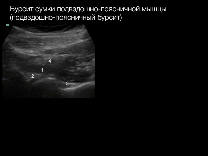 Бурсит сумки подвздошно-поясничной мышцы (подвздошно-поясничный бурсит)