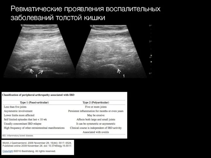 Ревматические проявления воспалительных заболеваний толстой кишки