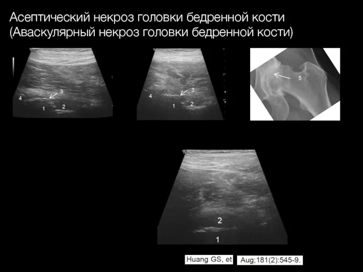 Асептический некроз головки бедренной кости (Аваскулярный некроз головки бедренной кости)