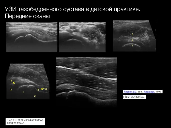 УЗИ тазобедренного сустава в детской практике. Передние сканы