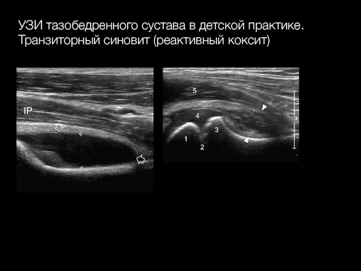 УЗИ тазобедренного сустава в детской практике. Транзиторный синовит (реактивный коксит)