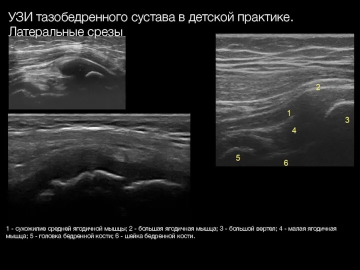 УЗИ тазобедренного сустава в детской практике. Латеральные срезы 1 - сухожилие