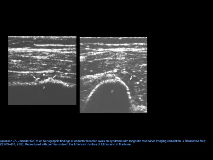 Jacobson JA, Jamadar DA, et al: Sonographic findings of adductor insertion