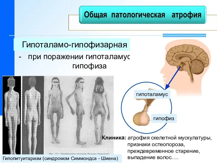 Гипоталамо-гипофизарная кахексия при поражении гипоталамуса или гипофиза гипоталамус гипофиз Гипопитуитаризм (синдромом