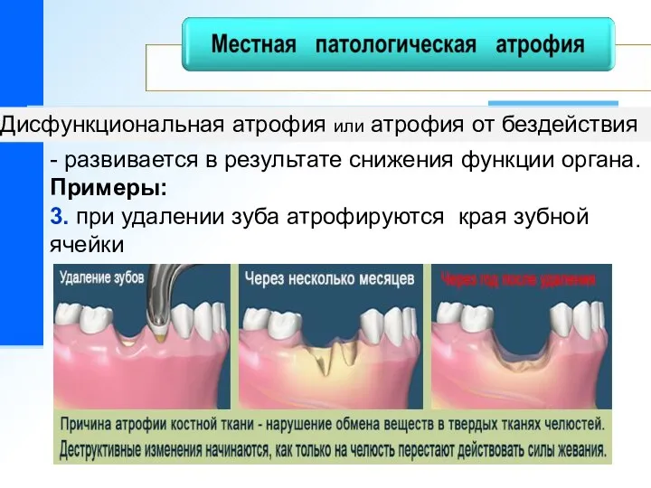 Дисфункциональная атрофия или атрофия от бездействия - развивается в результате снижения