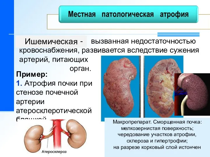Ишемическая Пример: 1. Атрофия почки при стенозе почечной артерии атеросклеротической бляшкой