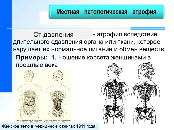 От давления - атрофия вследствие длительного сдавления органа или ткани, которое