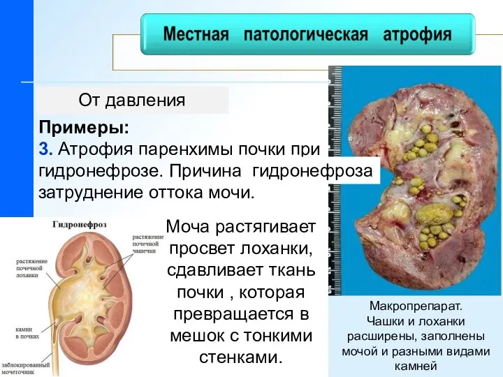 От давления Моча растягивает просвет лоханки, сдавливает ткань почки , которая