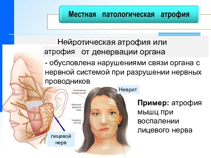 Нейротическая атрофия или от денервации органа атрофия - обусловлена нарушениями связи