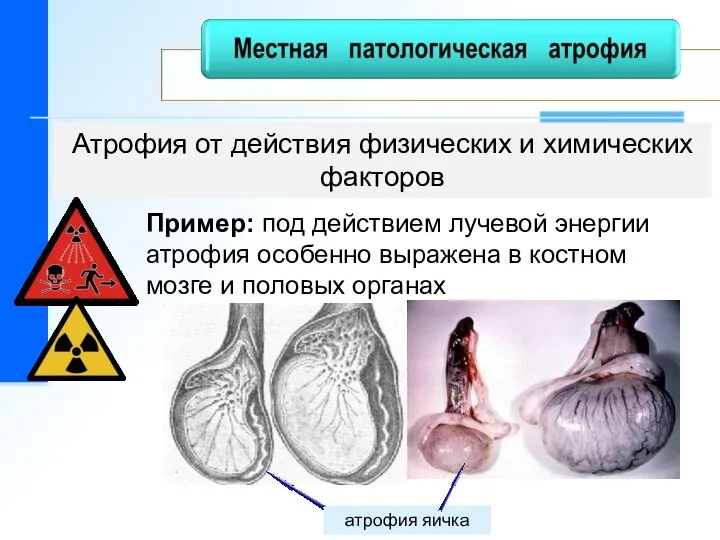 Атрофия от действия физических и химических факторов атрофия яичка Пример: под