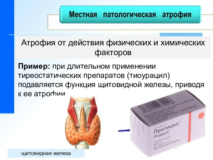 Атрофия от действия физических и химических факторов щитовидная железа Пример: при