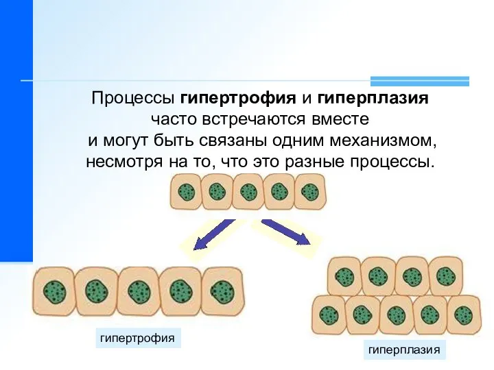 Процессы гипертрофия и гиперплазия часто встречаются вместе и могут быть связаны