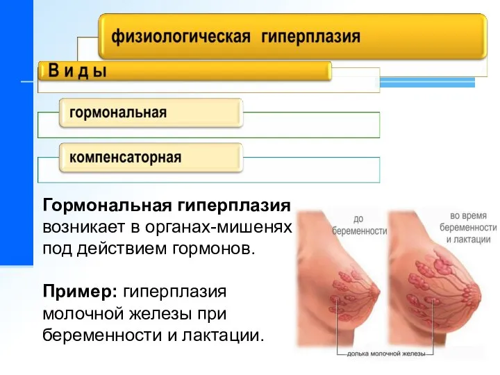 Гормональная гиперплазия возникает в органах-мишенях под действием гормонов. Пример: гиперплазия молочной железы при беременности и лактации.