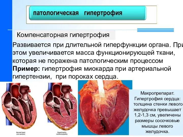 Развивается при длительной гиперфункции органа. При этом увеличивается масса функционирующей ткани,