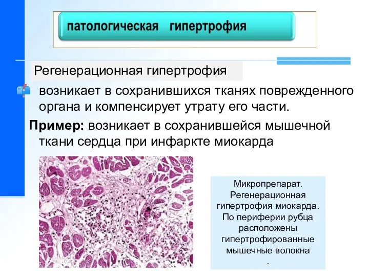 возникает в сохранившихся тканях поврежденного органа и компенсирует утрату его части.