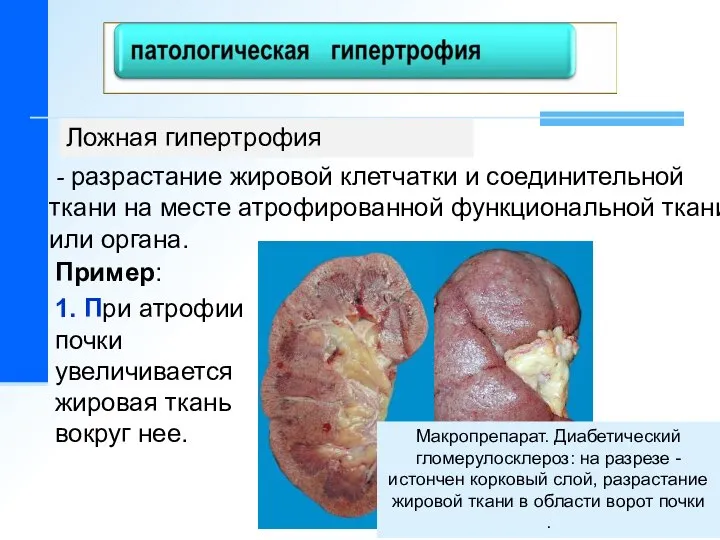 - разрастание жировой клетчатки и соединительной ткани на месте атрофированной функциональной