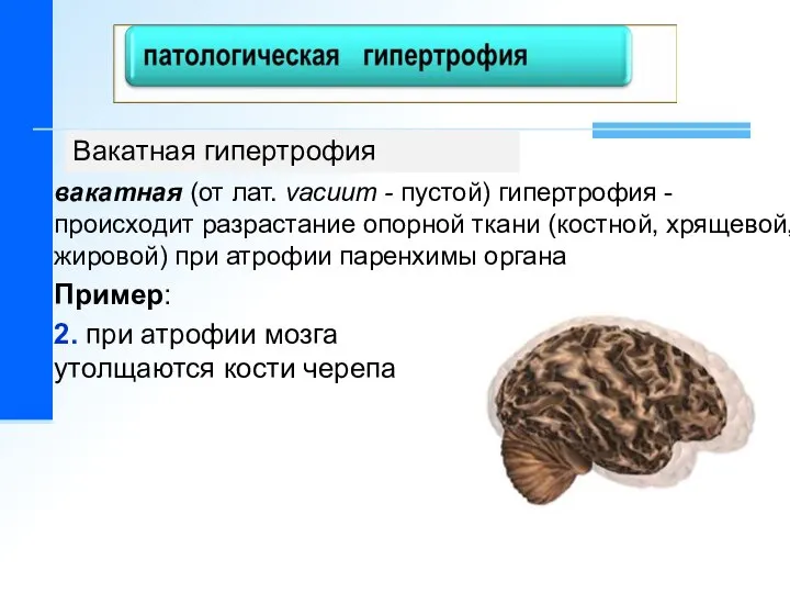 вакатная (от лат. vacuum - пустой) гипертрофия - происходит разрастание опорной