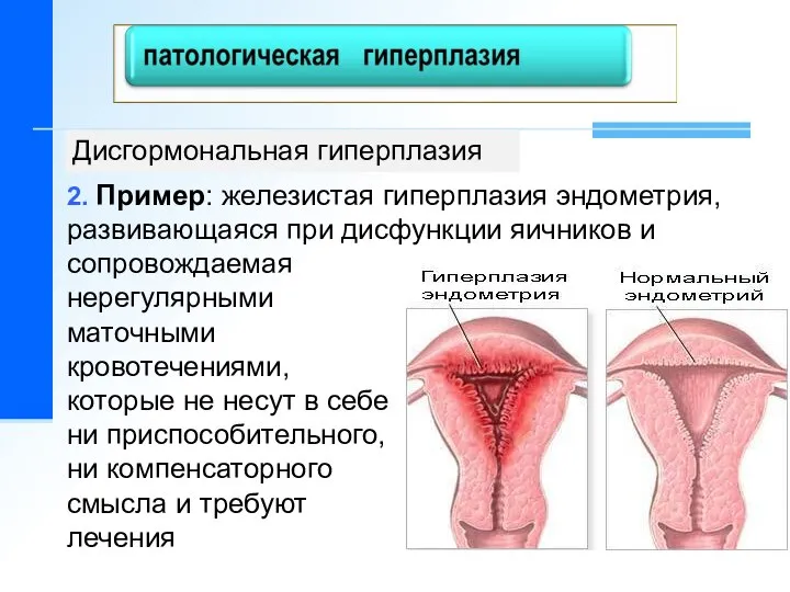 Дисгормональная гиперплазия 2. Пример: железистая гиперплазия эндометрия, развивающаяся при дисфункции яичников