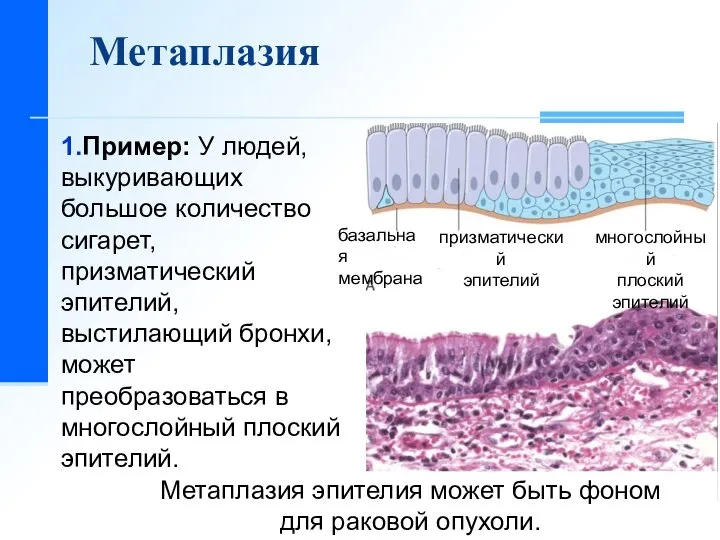 1.Пример: У людей, выкуривающих большое количество сигарет, призматический эпителий, выстилающий бронхи,