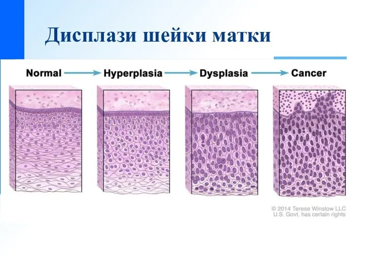 Дисплази шейки матки В соответствии со степенью пролиферации и выраженностью клеточной