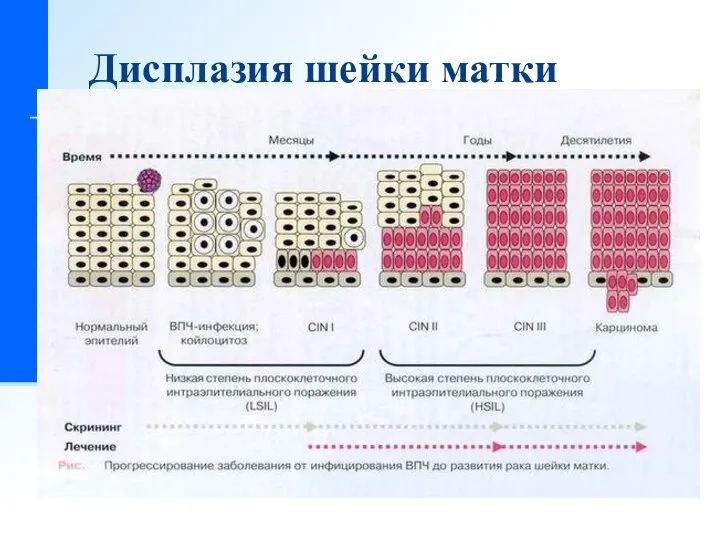 Дисплазия шейки матки