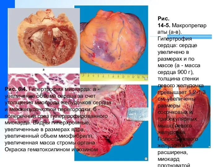 Рис. 14-5. Макропрепараты (а-в). Гипертрофия сердца: сердце увеличено в размерах и