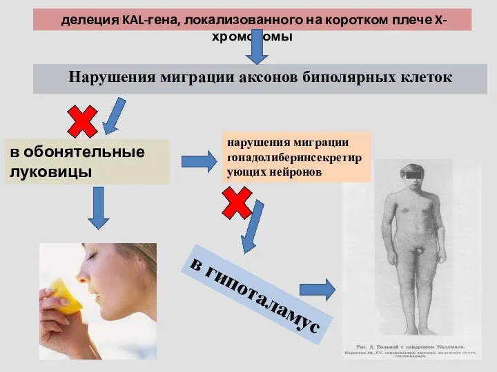 Нарушения миграции аксонов биполярных клеток в обонятельные луковицы нарушения миграции гонадолиберинсекретирующих