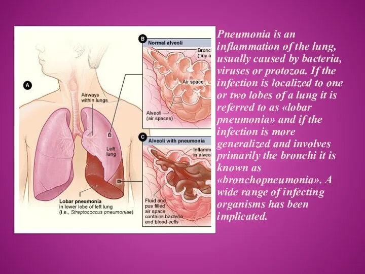 Pneumonia is an inflammation of the lung, usually caused by bacteria,