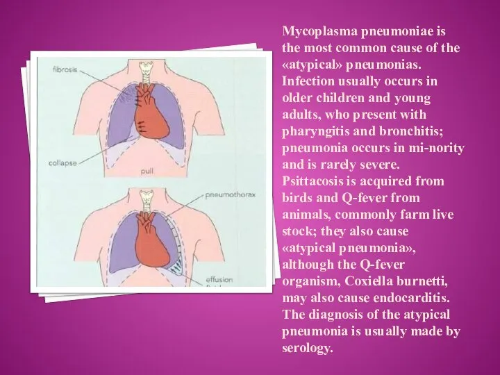 Mycoplasma pneumoniae is the most common cause of the «atypical» pneumonias.