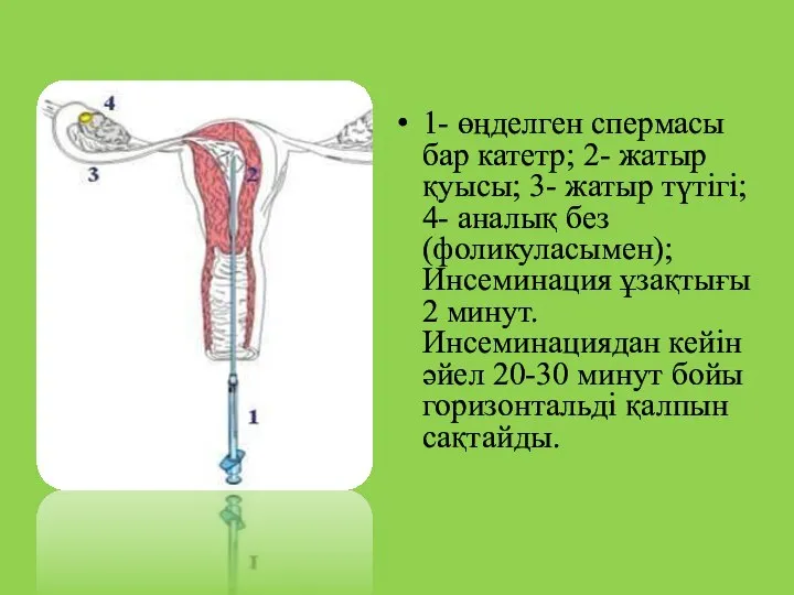 1- өңделген спермасы бар катетр; 2- жатыр қуысы; 3- жатыр түтігі;