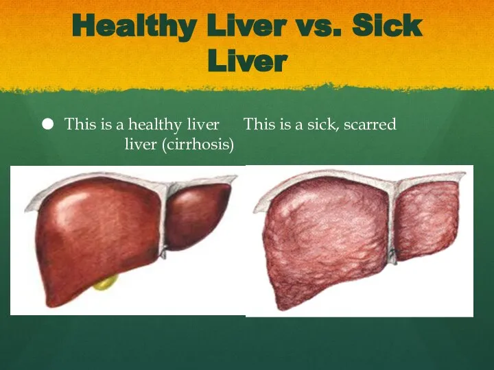 Healthy Liver vs. Sick Liver This is a healthy liver This