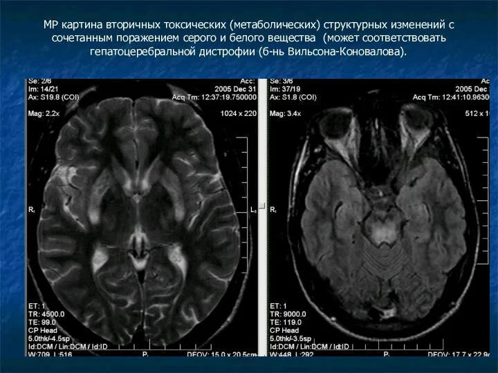 МР картина вторичных токсических (метаболических) структурных изменений с сочетанным поражением серого