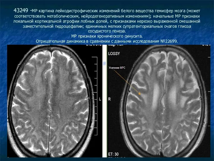 43249 -МР картина лейкодистрофических изменений белого вещества гемисфер мозга (может соответствовать