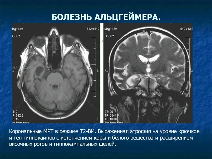 БОЛЕЗНЬ АЛЬЦГЕЙМЕРА. Корональные МРТ в режиме Т2-ВИ. Выраженная атрофия на уровне