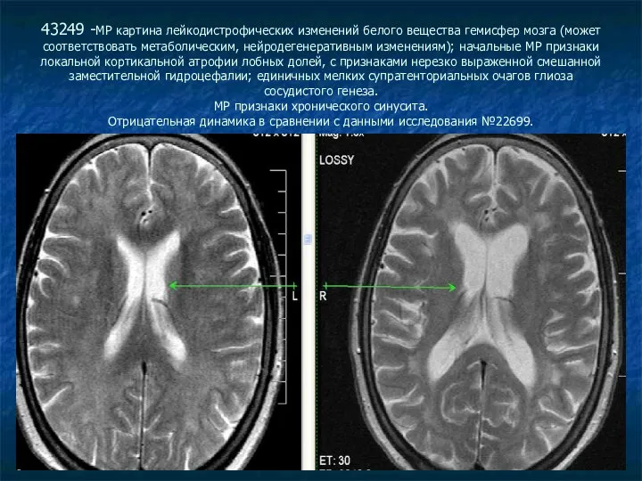 43249 -МР картина лейкодистрофических изменений белого вещества гемисфер мозга (может соответствовать