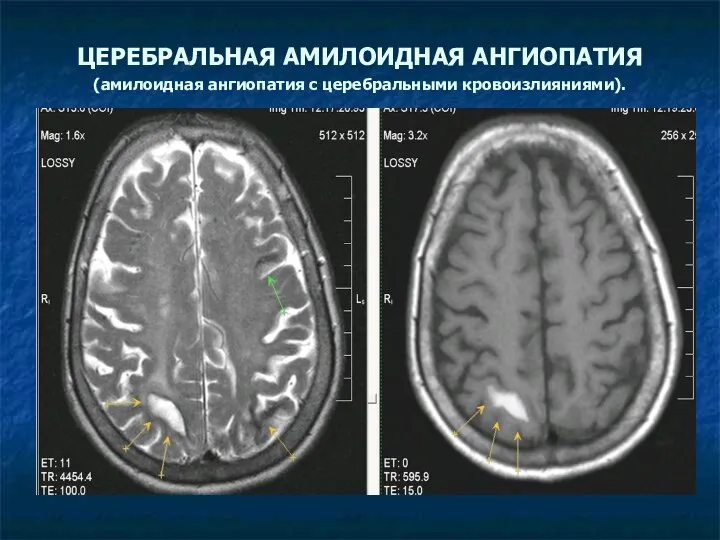 ЦЕРЕБРАЛЬНАЯ АМИЛОИДНАЯ АНГИОПАТИЯ (амилоидная ангиопатия с церебральными кровоизлияниями).