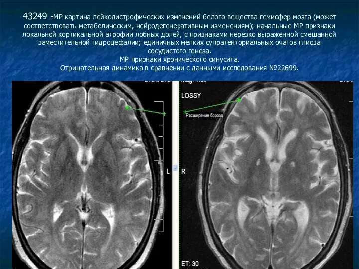 43249 -МР картина лейкодистрофических изменений белого вещества гемисфер мозга (может соответствовать