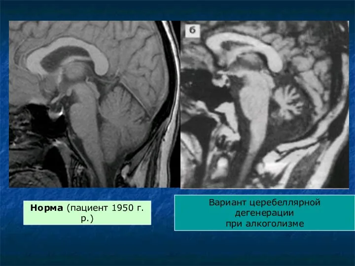 Норма (пациент 1950 г.р.) Вариант церебеллярной дегенерации при алкоголизме