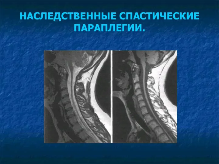 НАСЛЕДСТВЕННЫЕ СПАСТИЧЕСКИЕ ПАРАПЛЕГИИ.