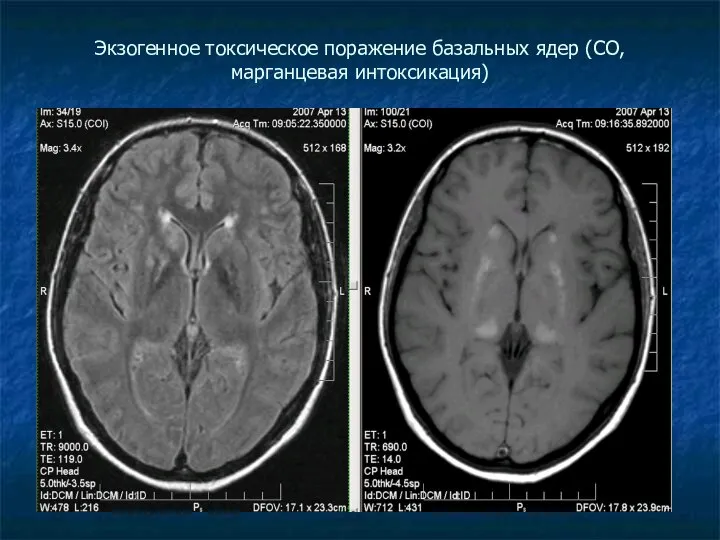 Экзогенное токсическое поражение базальных ядер (СО, марганцевая интоксикация)