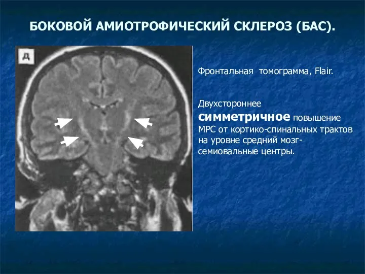БОКОВОЙ АМИОТРОФИЧЕСКИЙ СКЛЕРОЗ (БАС). Фронтальная томограмма, Flair. Двухстороннее симметричное повышение МРС