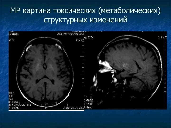 МР картина токсических (метаболических) структурных изменений