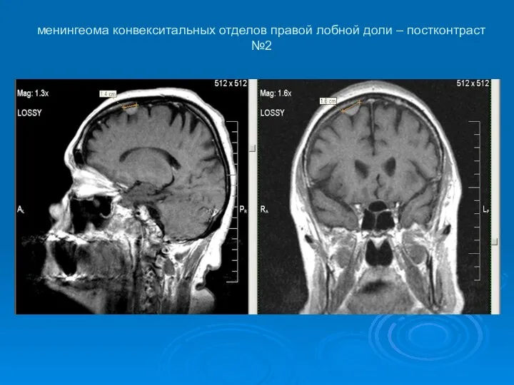 менингеома конвекситальных отделов правой лобной доли – постконтраст №2