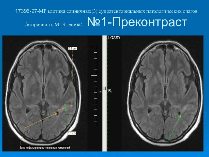 17396-97-МР картина единичных(3) супратенториальных патологических очагов /вторичного, МТS генеза/. №1-Преконтраст