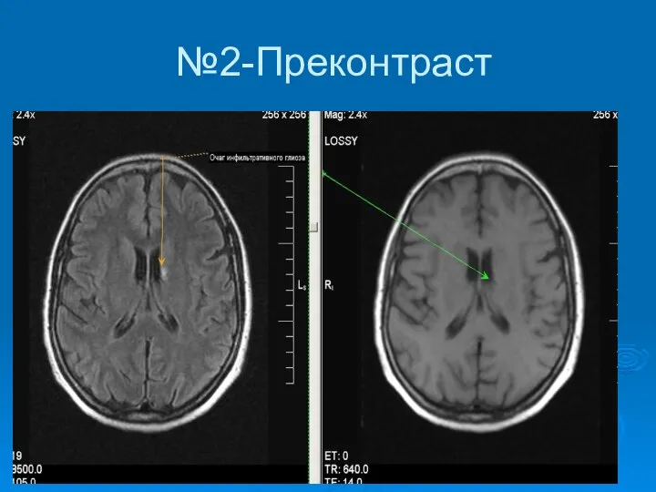 №2-Преконтраст