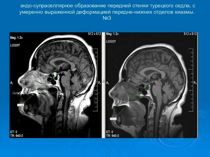 эндо-супраселлярное образование передней стенки турецкого седла, с умеренно выраженной деформацией передне-нижних отделов хиазмы. №3