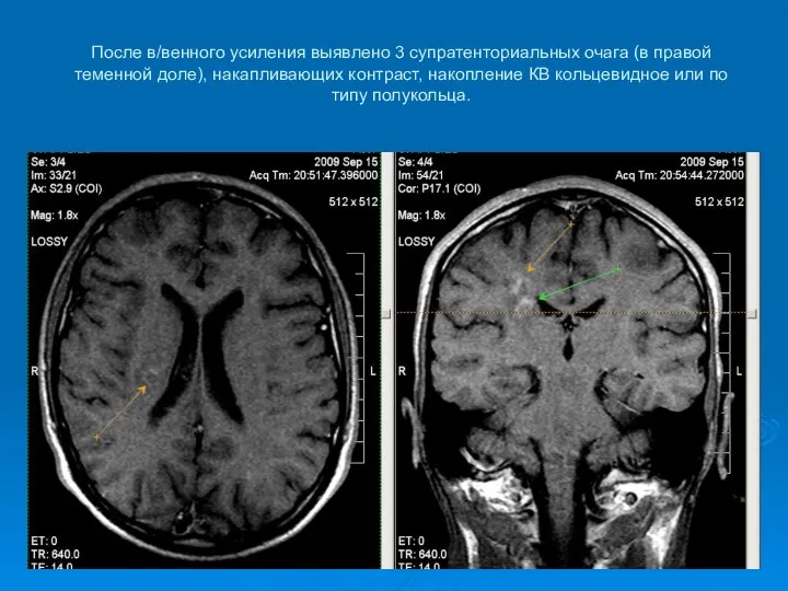 После в/венного усиления выявлено 3 супратенториальных очага (в правой теменной доле),